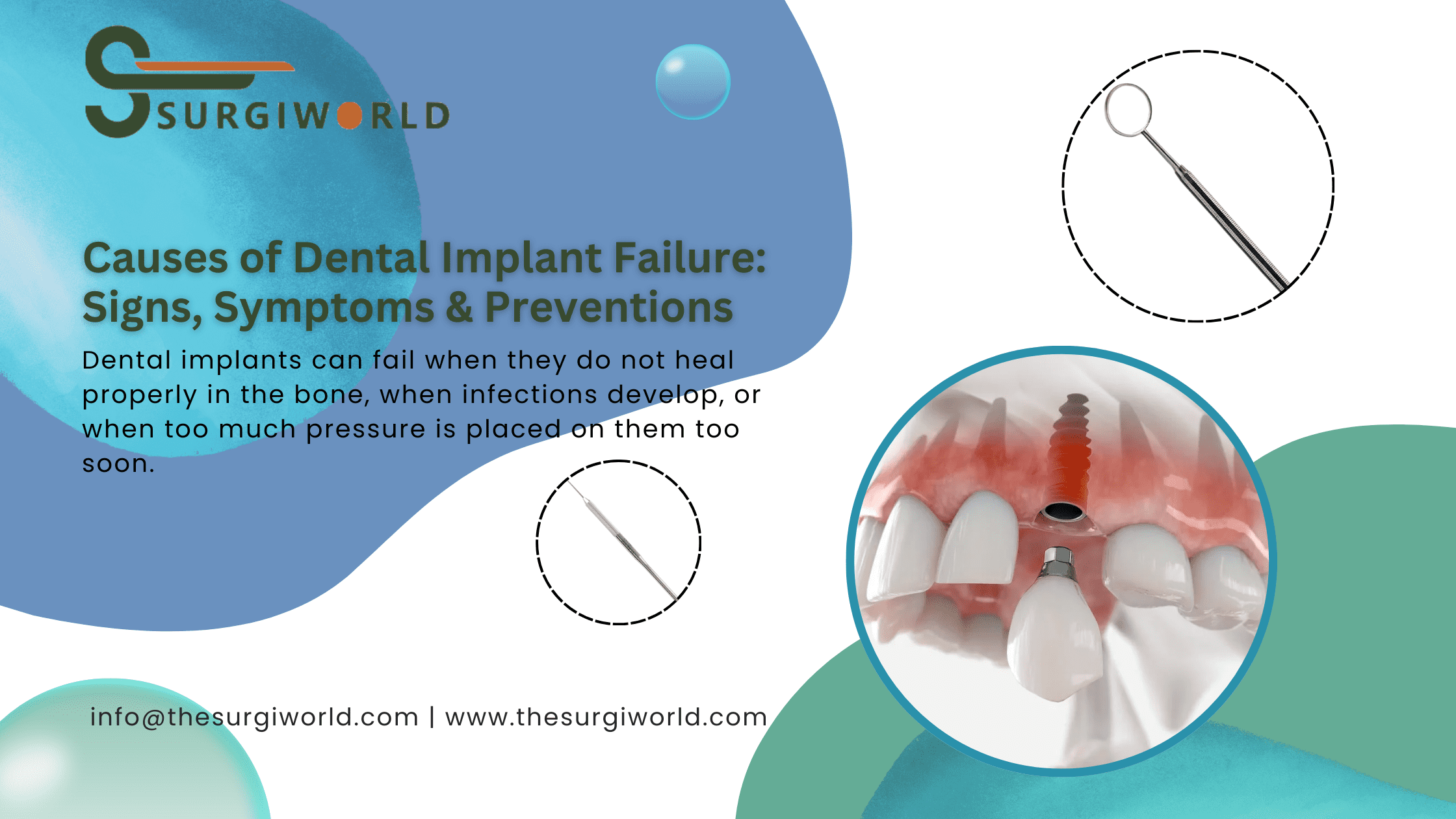 Causes of Dental Implant Failure: Signs, Symptoms & Preventions